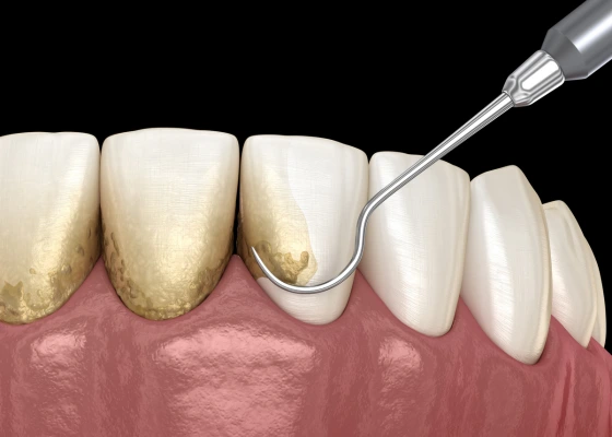 Pg Limpieza Dental Pro 3
